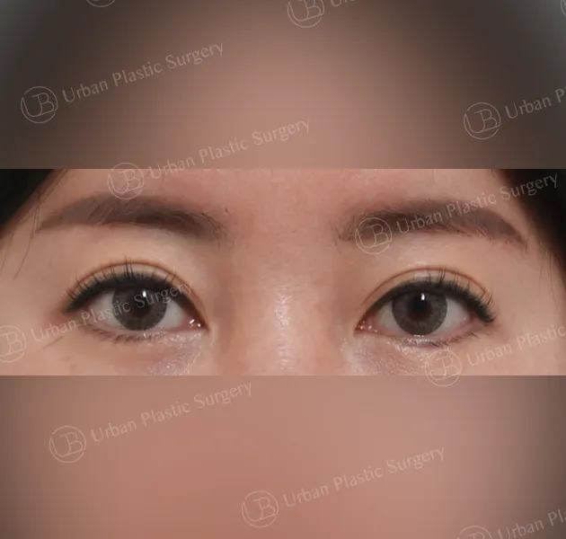 Incisional double eyelid, After, Front