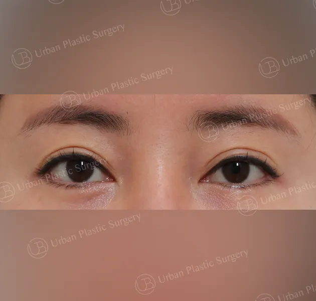 Incisional double eyelid, Before, Front