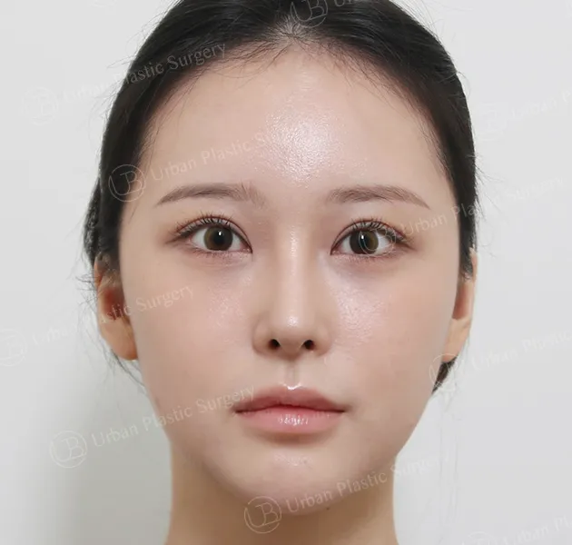 Eye revision, After, Front
