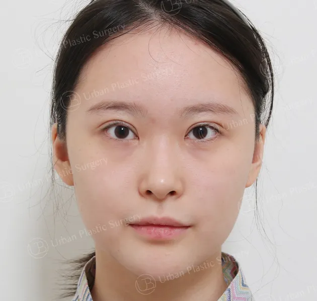 Eye revision, Before, Front