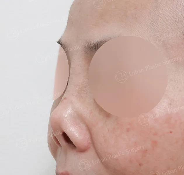 Open rhinoplasty, Before, 45°, Case J6f4B