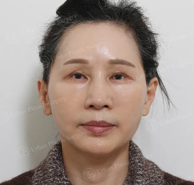 Anti-aging, After, Front