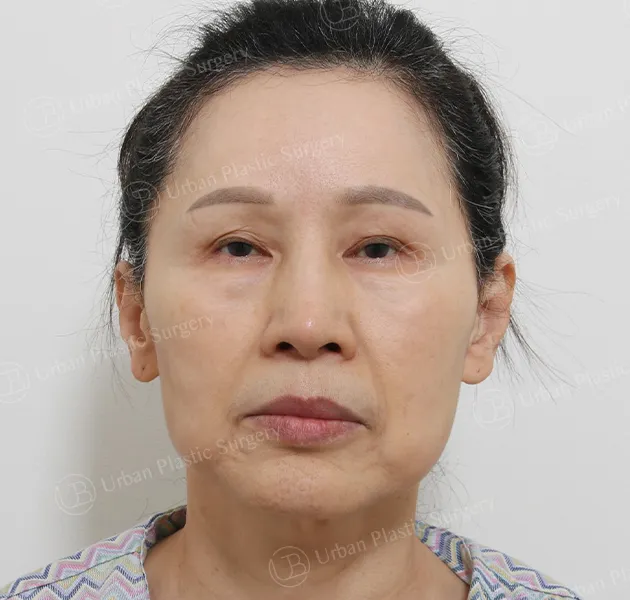 Anti-aging, Before, Front