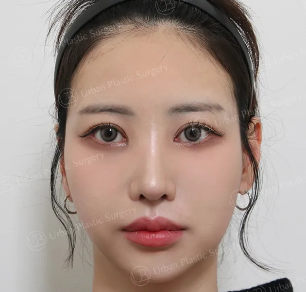 Nose revision, After, Front, Case Jt64v