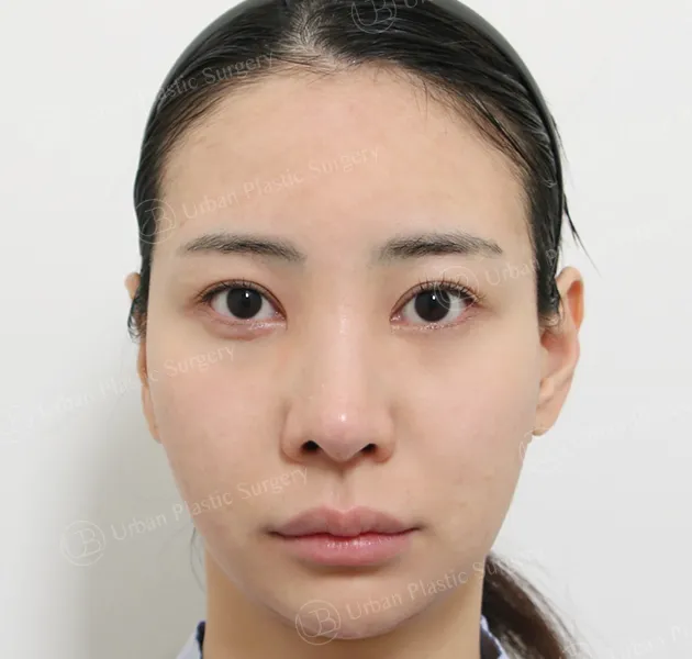 Nose revision, Before, Front, Case Jt64v