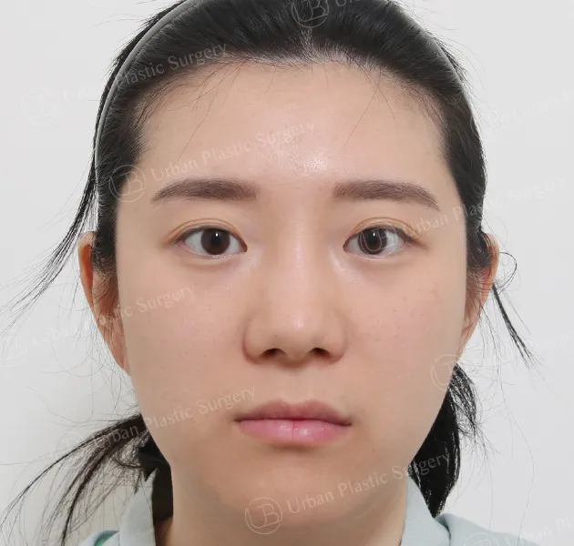 Eyes, Before, Front