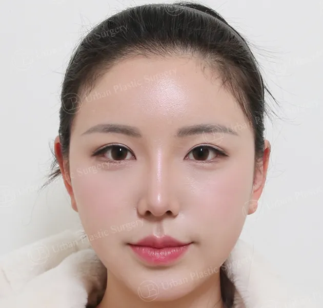 Eye revision, After, Front