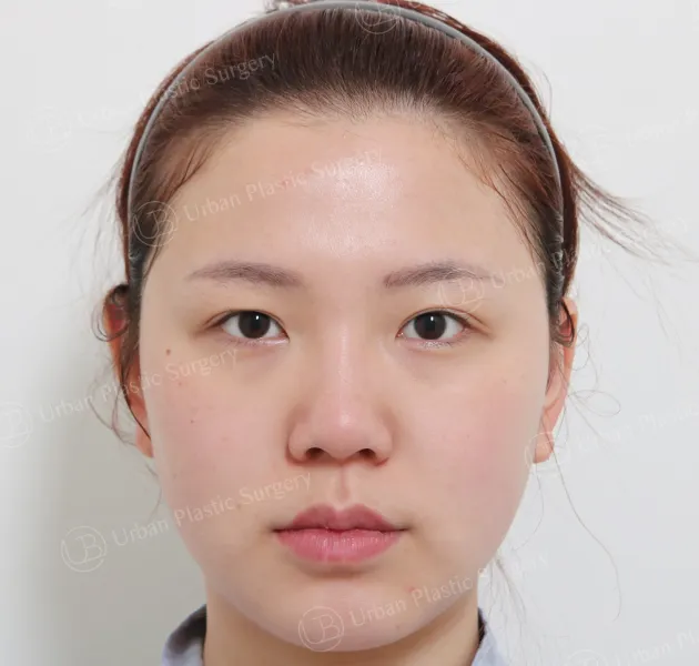 Eye revision, Before, Front