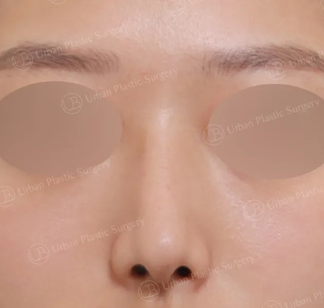 Open rhinoplasty, After, Front