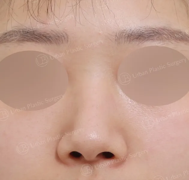 Open rhinoplasty, Before, Front