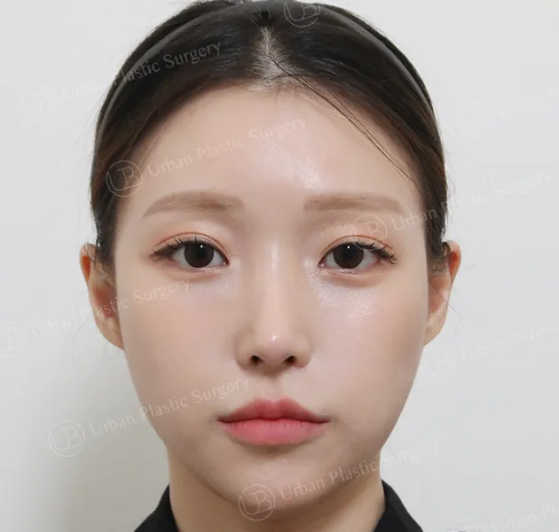 Eyes, After, Front, Case L3oT4