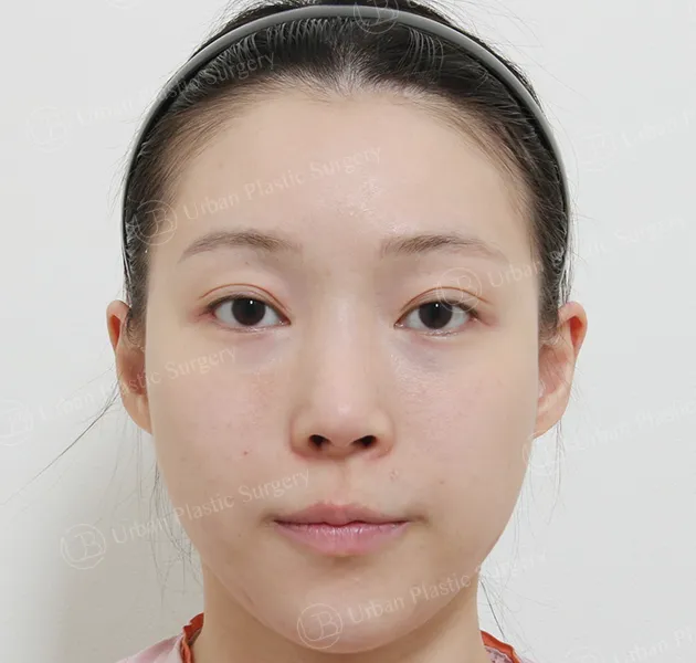 Eyes, Before, Front, Case L3oT4