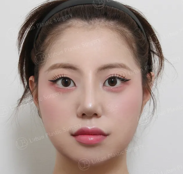 Rhinoplasty, After, Front, Case Me3Wn