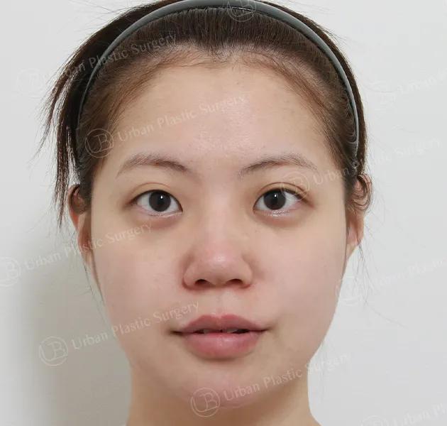 Rhinoplasty, Before, Front, Case Me3Wn
