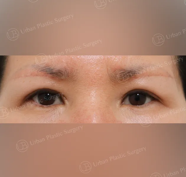 Sub-brow lift, After, Front
