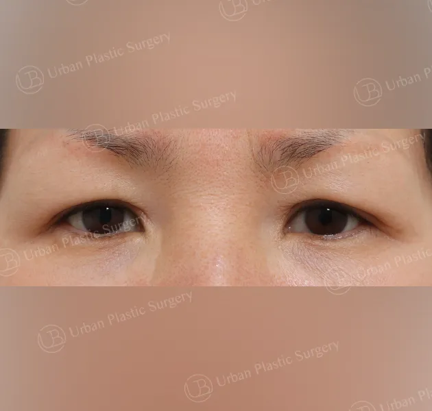 Sub-brow lift, Before, Front