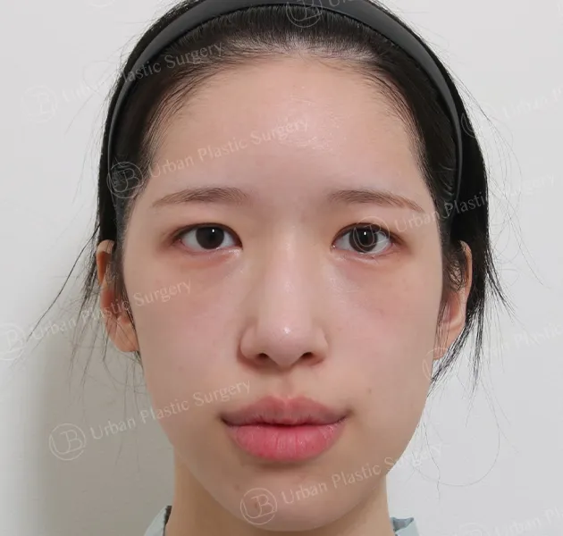 Eye revision, Before, Front