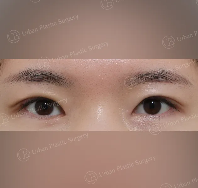 Inner corner reversal, After, Front, Case NZqMF