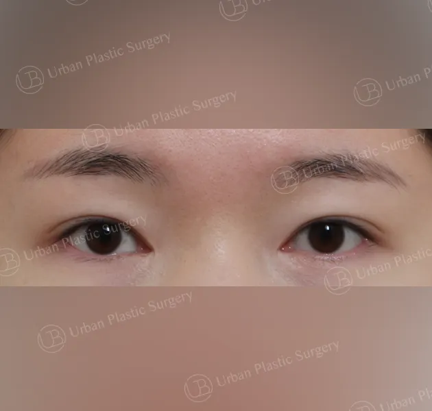 Inner corner reversal, Before, Front, Case NZqMF