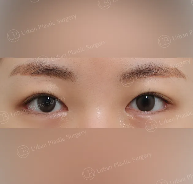 Dual canthoplasty, After, Front