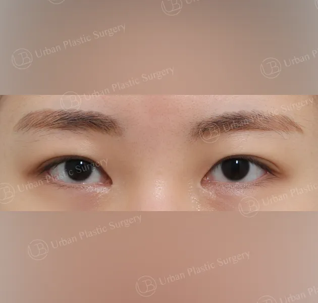 Dual canthoplasty, Before, Front