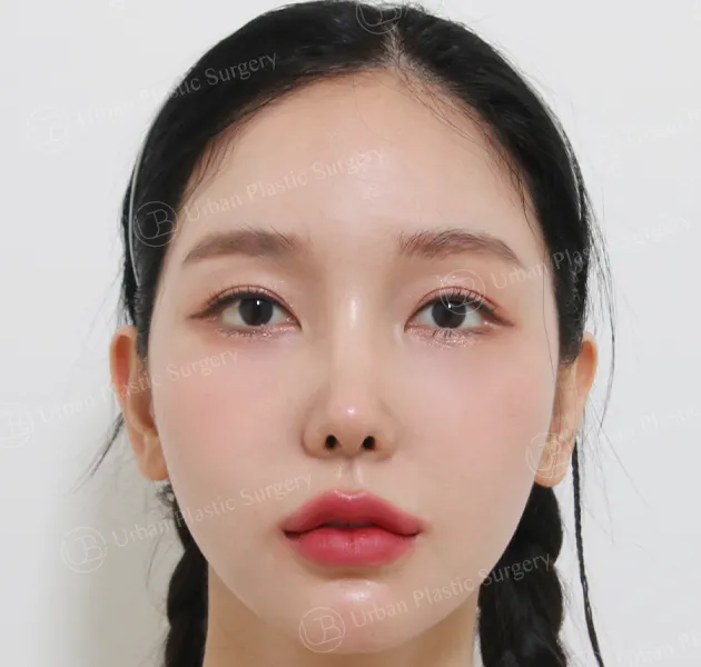 Rhinoplasty, After, Front