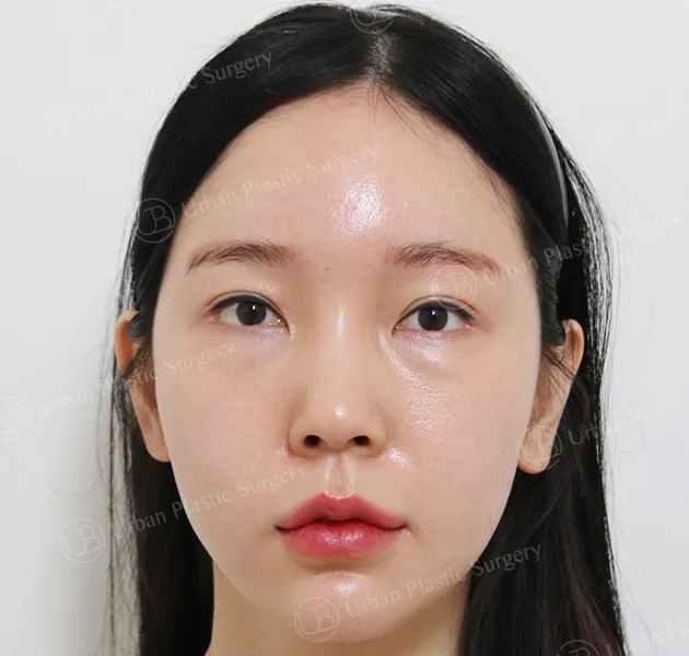 Rhinoplasty, Before, Front