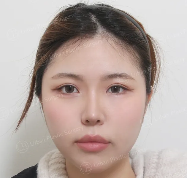 Eye revision, After, Front
