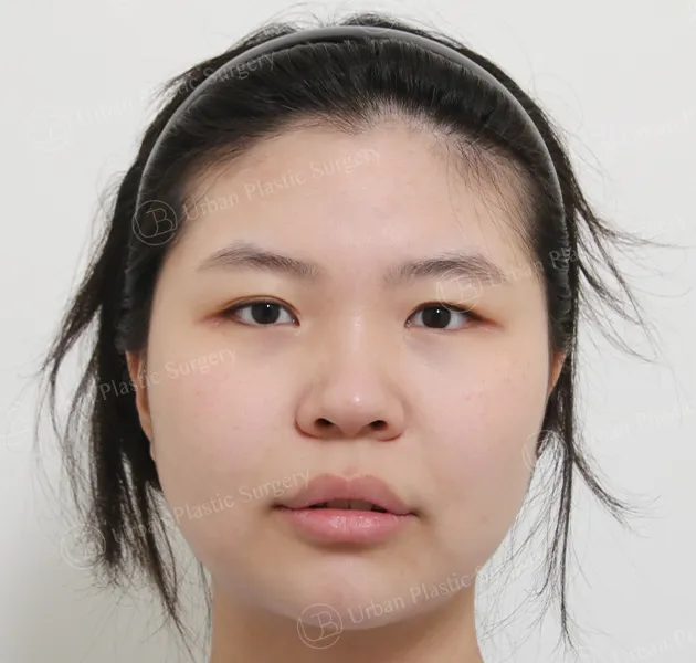 Eye revision, Before, Front