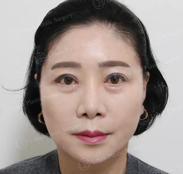 拉皮,術後,正面,案例 PVyPx