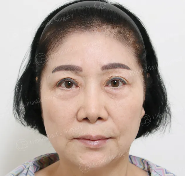 拉皮,術前,正面,案例 PVyPx