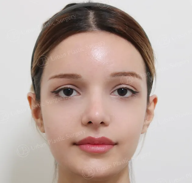 Rhinoplasty, After, Front