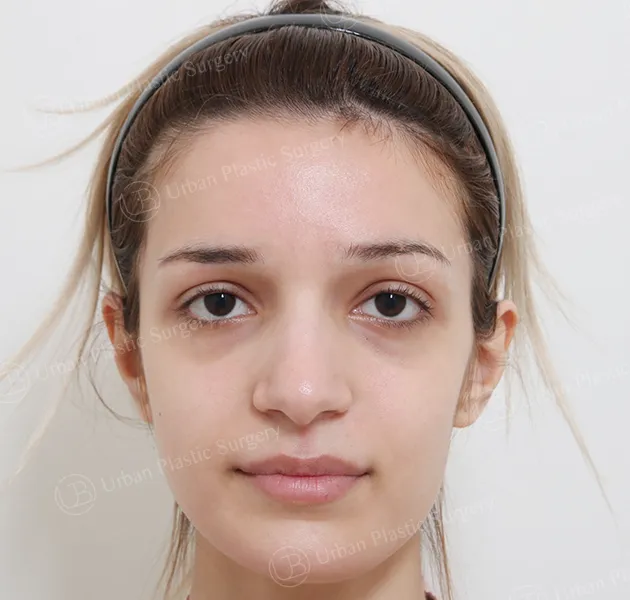 Rhinoplasty, Before, Front