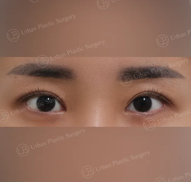 Incisional ptosis correction, After, Front