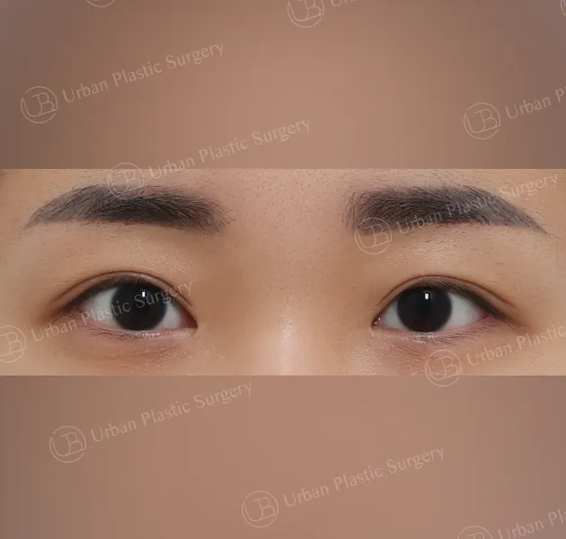 Incisional ptosis correction, Before, Front