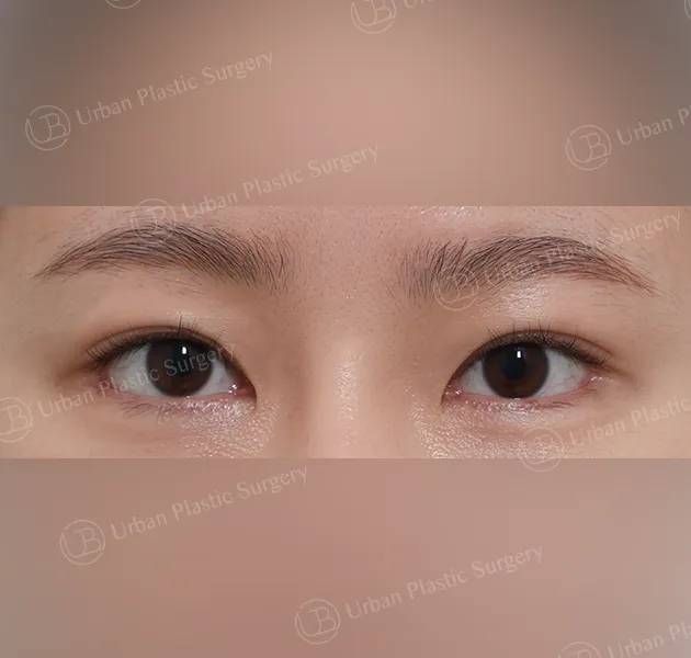 Outer corner (lateral canthoplasty), After, Front