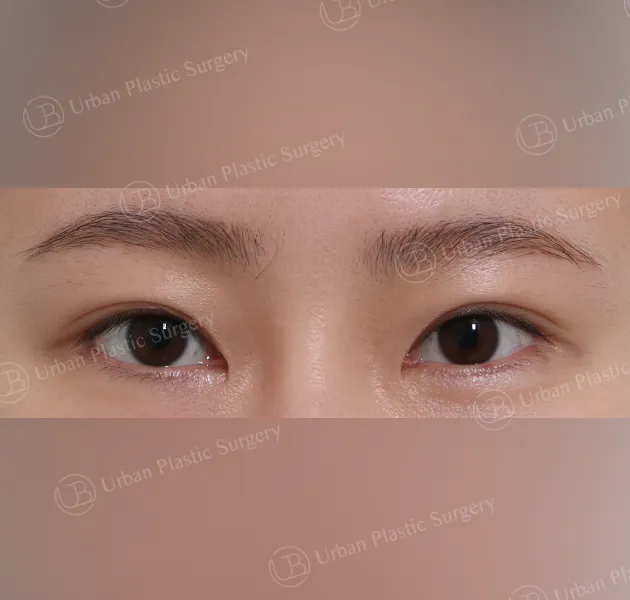 Outer corner (lateral canthoplasty), Before, Front