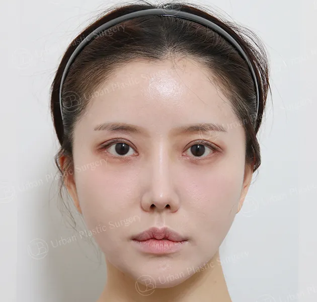 Nose revision, After, Front