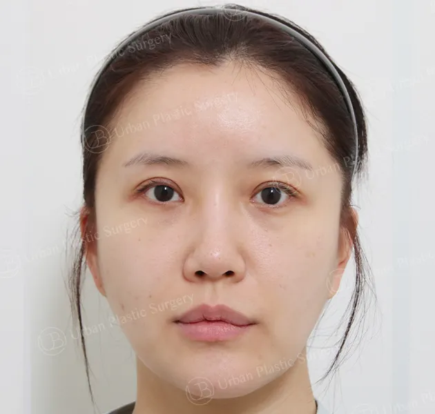 Nose revision, Before, Front