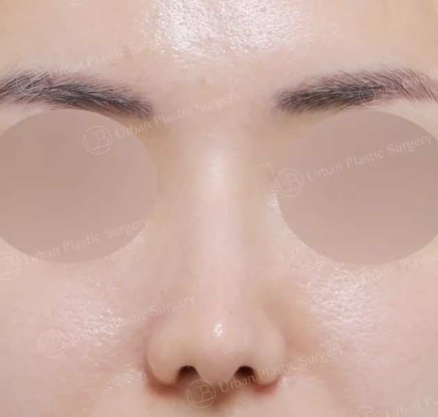 Implant-free rhinoplasty, After, Front