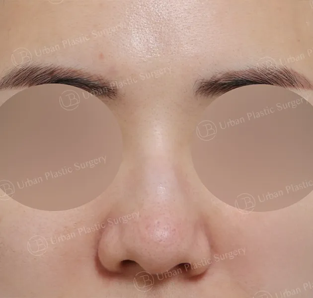 Implant-free rhinoplasty, Before, Front