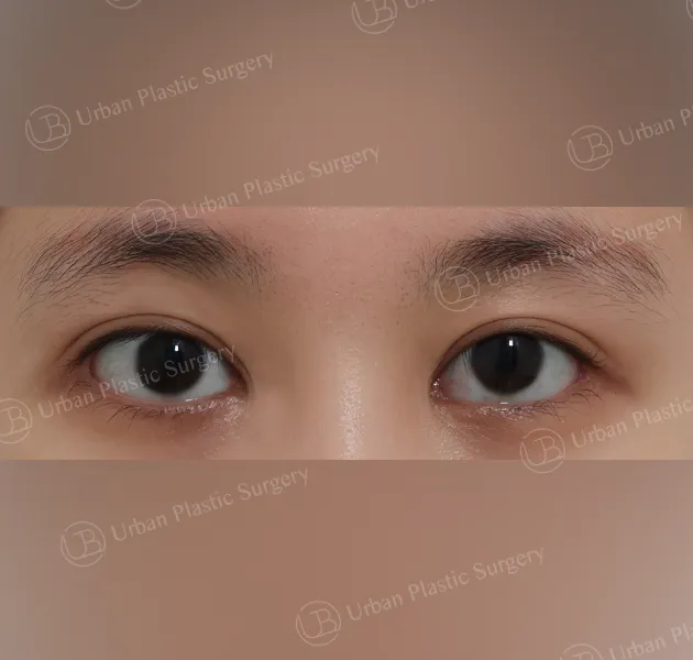 Incisional ptosis correction, After, Front
