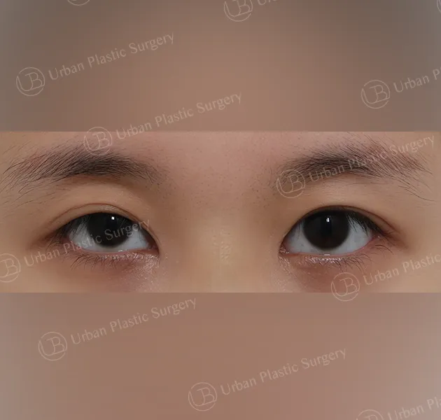 Incisional ptosis correction, Before, Front