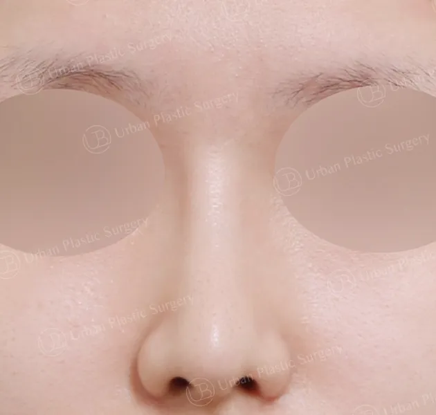 Open rhinoplasty, After, Front