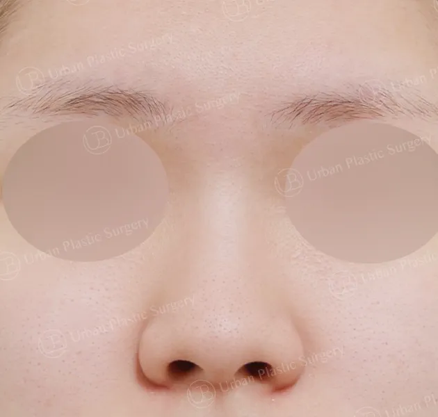 Open rhinoplasty, Before, Front