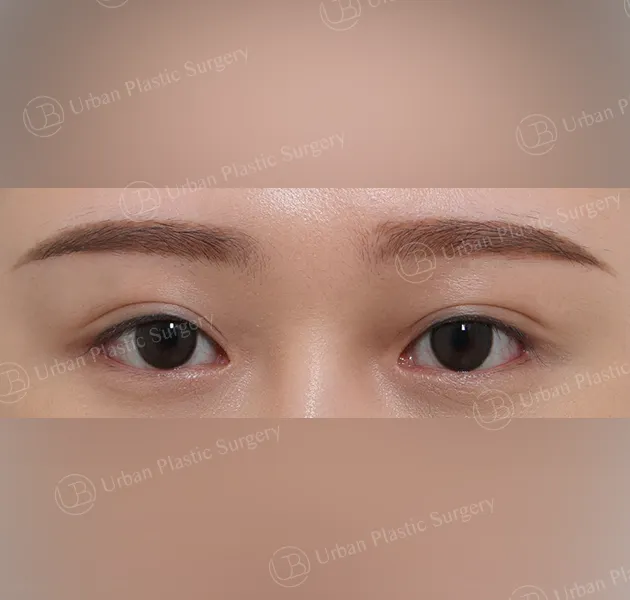 Non-incisional ptosis correction, After, Front