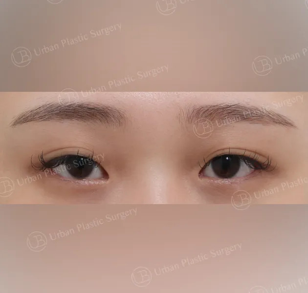 Non-incisional ptosis correction, Before, Front