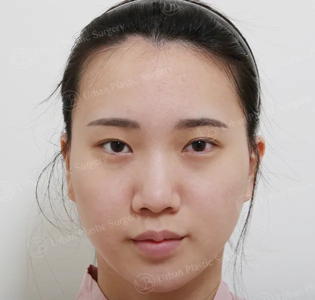 Eyes, Before, Front