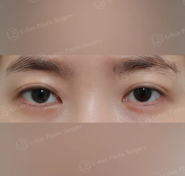 Suture double eyelid, After, Front, Case TqRPu
