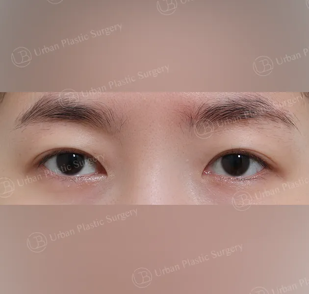 Suture double eyelid, Before, Front, Case TqRPu